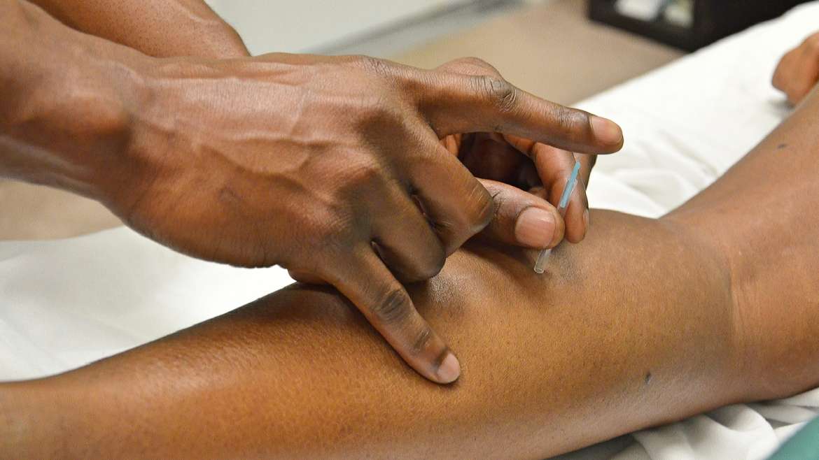 Acupuncture